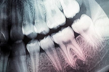 Анатомия зуба: каналы зуба