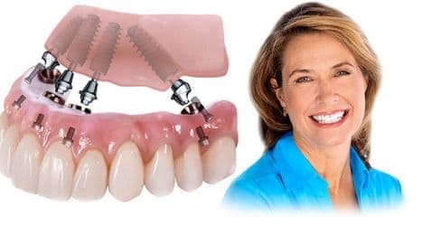 Лечение всех зубов за один прием