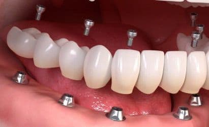 Все зубы за 1 день лечение