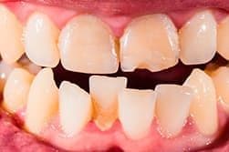 Кривые зубы – не только эстетический дефект, они могут косвенно влиять на функциональность всего организма.