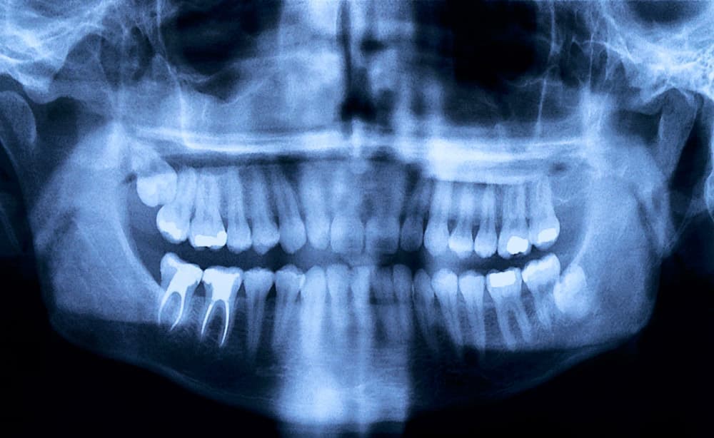 Рентген-снимок (запломбированные корни зуба).
