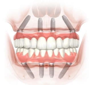Лечение всех зубов за один день