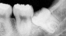 ретинированный зуб что такое
