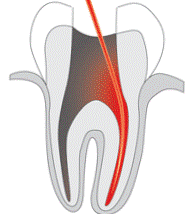 Как удаляют нерв в зубе?