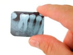 Как правильно делать рентген зубов?