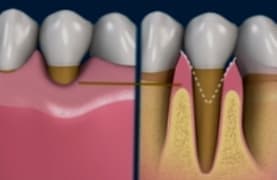 Клиновидный дефект зубов характеризуется глубокими трещинами и углублениями в пришеечной зоне.