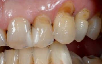 Лечение клиновидного дефекта должно начаться как можно раньше, поскольку с углублением трещин есть угроза того, что зуб обломится