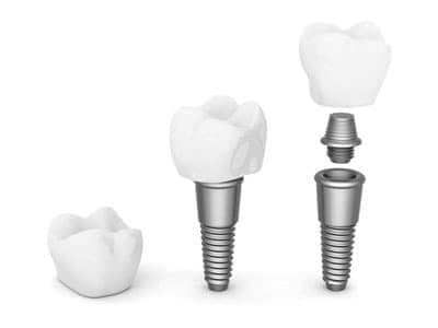 Рейтинг имплантов: какой имплант зуба лучше?