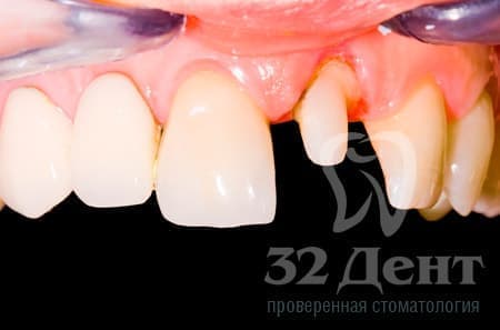 вкладка коронка
