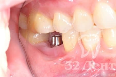 Для сомневающихся: стоит ли ставить импланты зубов