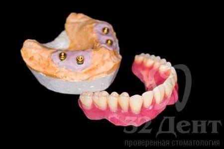 Какой съемный протез удобнее для нижней челюсти