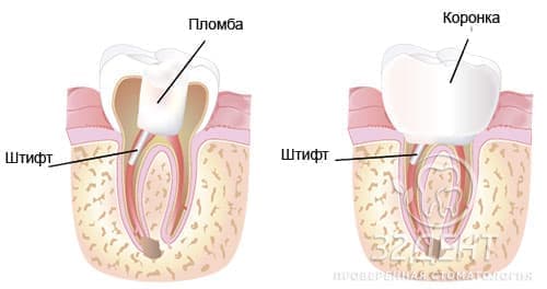 Функциональные особенности зубов на штифтах