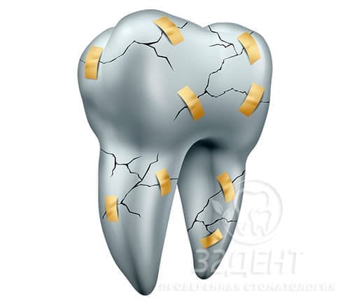 Методы лечения трещин на зубах