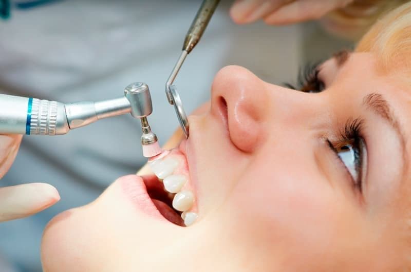После снятия отложений на зубы наносится фторсодержащий компонент.