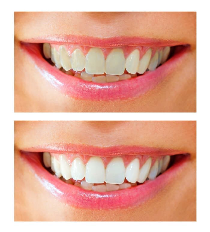 Эффект чистки зубов AirFlow – фото до и после процедуры.