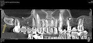  Рентген-снимок дистопированного зуба мудрости (неправильно расположенного в челюсти)