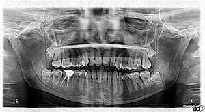  Рентген-снимок дистопированного зуба мудрости (неправильно расположенного в челюсти)