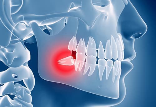 Воспаление при прорезывании зубов