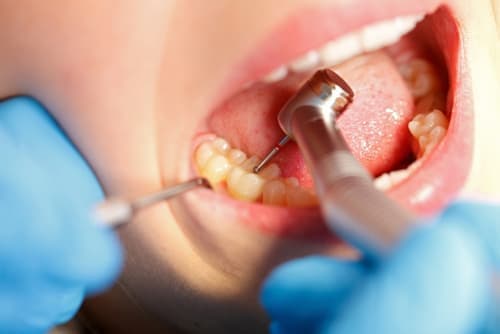 Лечение периодонтита в стоматологии