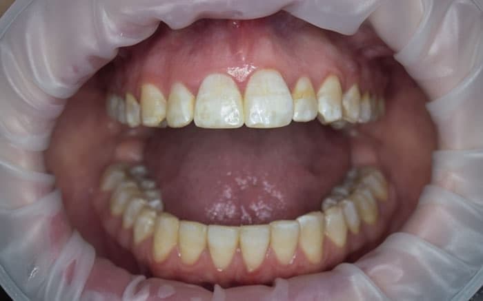 Белые пятна на эмали зубов