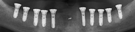 Программный комплекс Implant-Assistant
