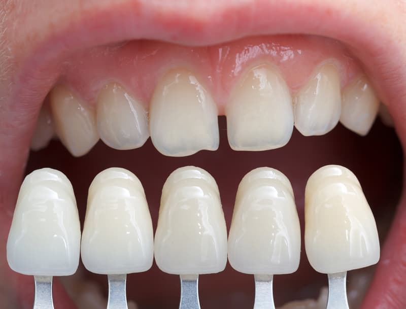 Люминиры позволяют исправить такие дефекты, как щели между зубами, а также небольшую кривизну и неровности.