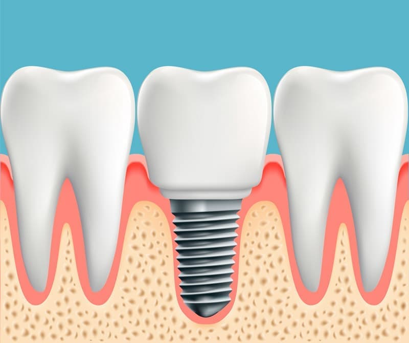 Несъемный тип протезирования при отсутствии одного зуба без обточки соседних зубов – имплантация.