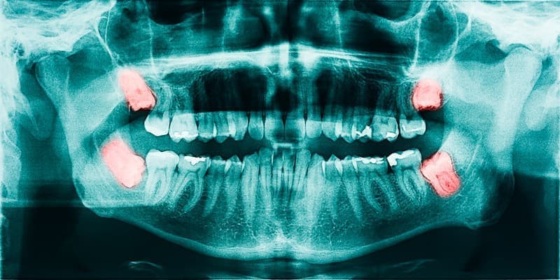 Рентген-снимок прорезывающихся зубов мудрости, вызвавших перикоронарит.