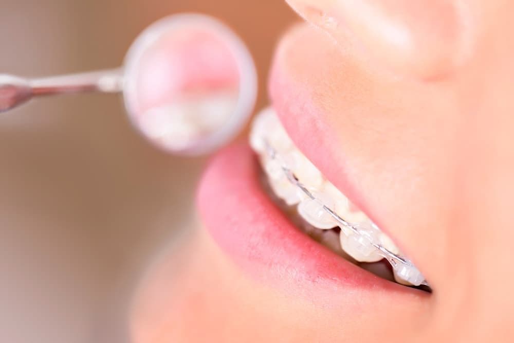 Сапфировые брекеты на зубах смотрятся очень эстетично, незаметно – скорее как аксессуар, а не стоматологическая конструкция.