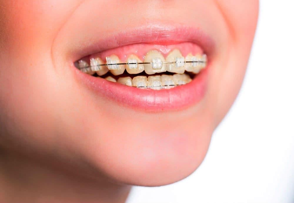 На желтых зубах сапфировые брекеты выделяются, подчеркивая желтизну зубов, поэтому перед установкой рекомендуется отбелить зубы.