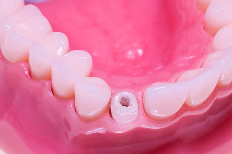 Штифт вставляют в канал зуба, фиксируя его пломбировочным материалом. 