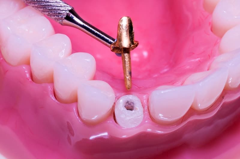 Штифт вставляют в зуб для придания прочности коронковой части зуба. 