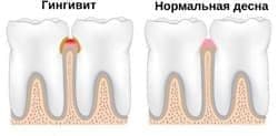 Лечение гингивита