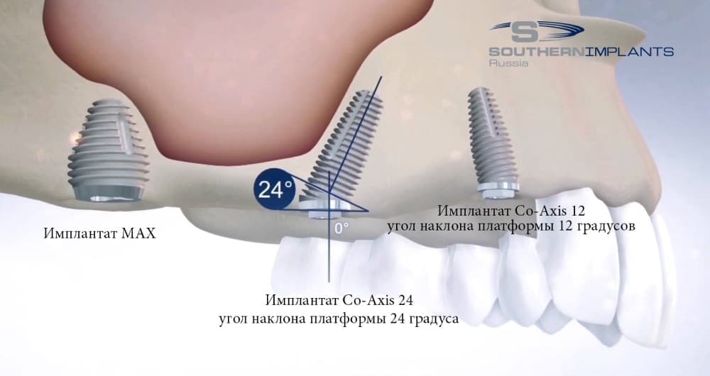 Имплантация без синус лифтинга