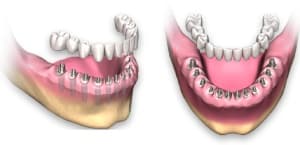 Имплантация зубов при полном отсутствии