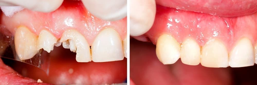 Керамические вкладки на передние зубы помогут восстановить целостность сильно разрушенных зубов. Внешне такие микропротезы не отличны от естественных тканей зубов.