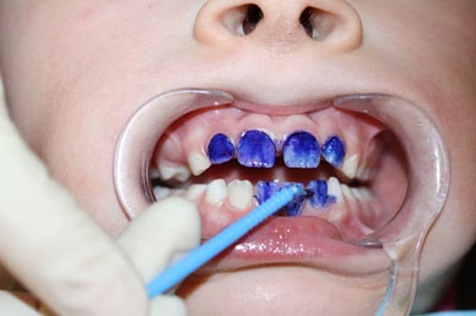 Процедура серебрения молочных зубов подразумевает нанесение на эмаль специального дезинфицирующего вещества, содержащего серебро и фтор.
