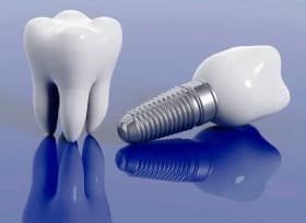 Преимущества экспресс имплантации зубов