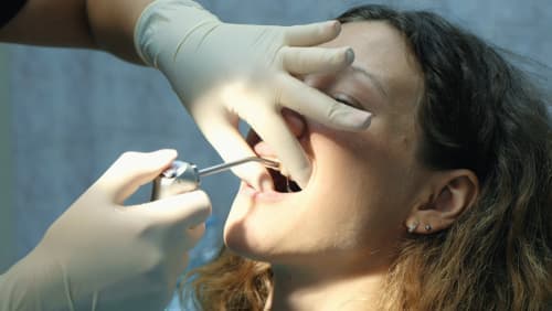 Способы снятия зубного налета 4