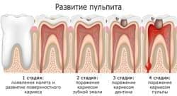 Лечение пульпита