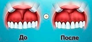Пластика уздечки верхней губы