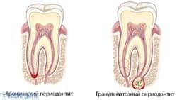 Лечение периодонтита