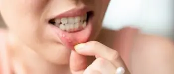 Стоматит