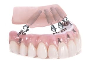 Имплантация верхних зубов по протоколу all-on-6