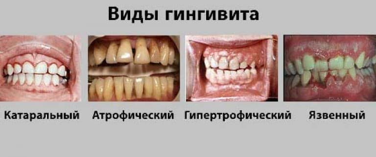 Лечение гингивита картинки Лечение гингивита картинки