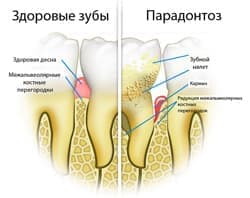 Лечение пародонтоза