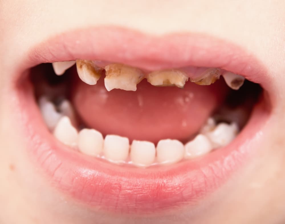 С лечением молочных зубов лучше не затягивать, от их здоровья зависит состояние постоянных зубов.