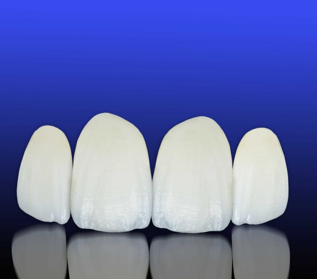 Керамическая реставрация зубов: надежно, долговечно, красиво