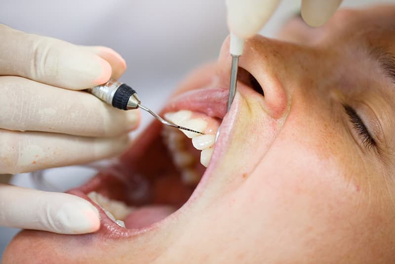 Перед лечением аппаратом Вектор стоматолог осматривает полость рта пациента и определяет объем обрабатываемой поверхности.