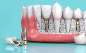 Однофазная имплантация зубов